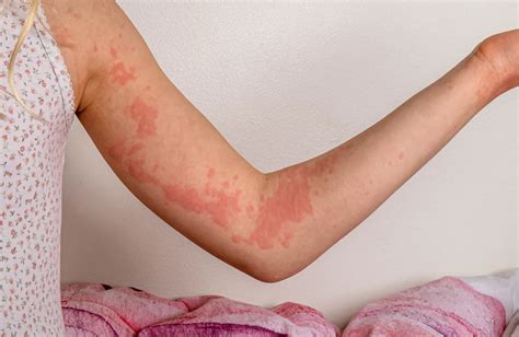 scratch test urticaria|urticaria can be treated with.